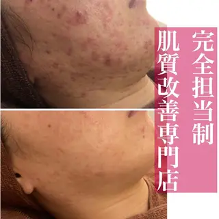 ニキビ跡改善専門🔥 医療にはできない改善のエステ・リラクイメージ