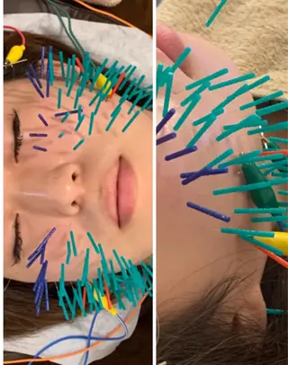 表参道鍼灸院K 美容鍼🔮ララピールのエステ・リラクイメージ