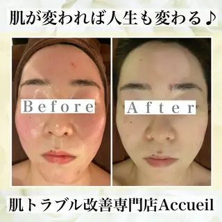 ニキビ・肌質改善専門 ♡人生が変わるサロンのエステ・リラクイメージ