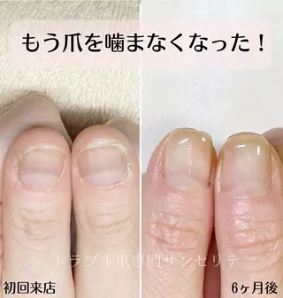 ネイル 深爪・巻き爪 専門サンセリテのネイルデザイン