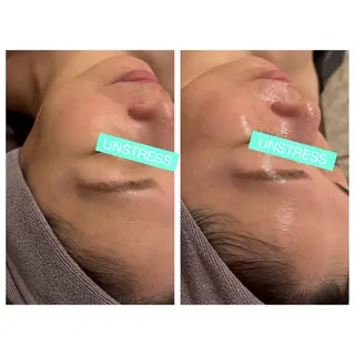 ☆痩身/小顔☆ ハイパーナイフexのエステ・リラクイメージ