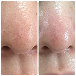 ニキビ特化美容鍼 ×ハーブピーリングのエステ・リラクイメージ