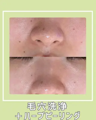 |ピーリング・毛穴| soina神楽坂のエステ・リラクイメージ