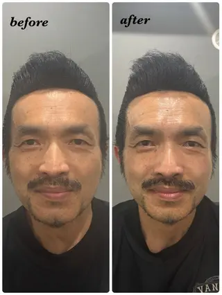 ハーブピーリング/韓国肌管理/フェイシャル/毛穴洗浄/眉毛/顔脱毛【糸脱毛専門】rev所属・ハーブピーリング🌹 毛穴洗浄❤️眉waxのエステ・リラクイメージ