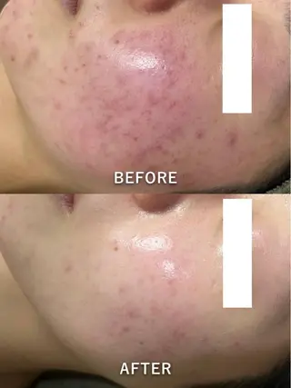 韓国美肌/肌質改善 【天神】yuiのエステ・リラクイメージ