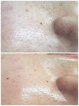 Chalon所属・REVI取扱・肌悩み 毛穴Chalonのエステ・リラクイメージ