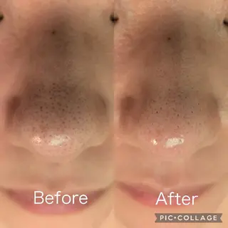 毛穴フェイシャルエステkokotto板橋所属・【毛穴ハーブピーリン グ】板橋1位のエステ・リラクイメージ