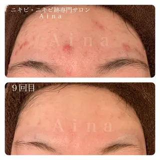 ニキビ跡専門サロン Ainaのエステ・リラクイメージ