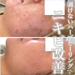 ニキビ・毛穴改善 🌿ハーブピーリングのエステ・リラクイメージ