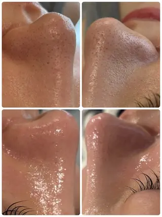 【リベルハーブピーリング認定店】敏感肌・美白脱毛専門店Dione立川店所属・Dione 立川店のエステ・リラクイメージ