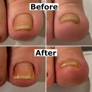 ネイル Mellow nail所属・巻爪無料モデル募集 ✨🦶MEGUMIのネイルデザイン