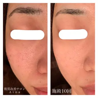 セミロング カラー パーマ ヘアアレンジ メンズ キッズ ネイル マツエク・マツパ ニキビ跡専門サロン Ainaのエステ・リラクイメージ