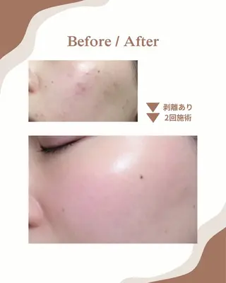 myherb所属・ニキビ肌改善サロン myherb🌿のエステ・リラクイメージ