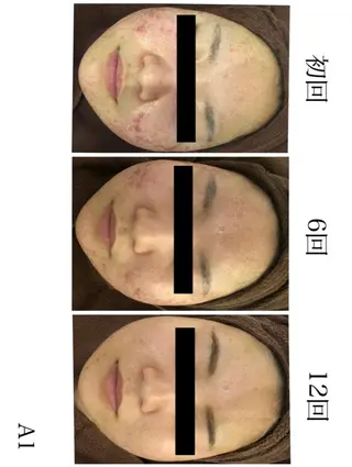 学生ニキビ改善🍀 優しい肌質改善のエステ・リラクイメージ