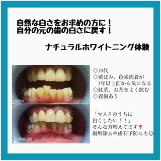 ネイル/耳つぼ /新ホワイトニングのネイルデザイン