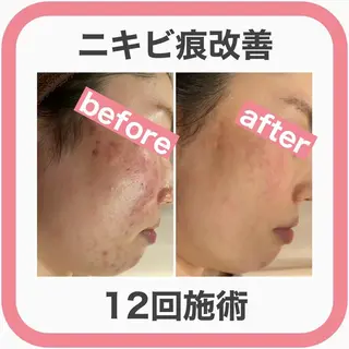 ニキビ跡改善専門🔥 医療にはできない改善のエステ・リラクイメージ