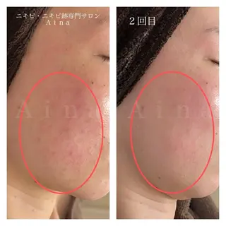 ニキビ跡専門サロン Ａｉｎａのエステ・リラクイメージ