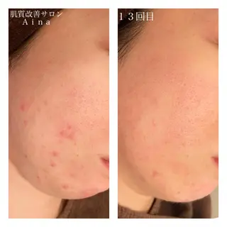 ロング カラー パーマ ヘアアレンジ メンズ ネイル マツエク・マツパ ニキビ跡専門サロン Ainaのエステ・リラクイメージ