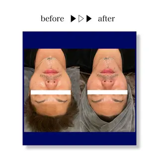 ☆痩身/小顔☆ ハイパーナイフexのエステ・リラクイメージ