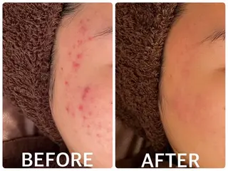 ハーブピーリング 🌿京橋のエステ・リラクイメージ