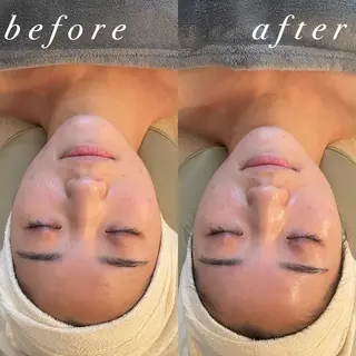 うなじ脱毛/美肌脱毛 LABELのエステ・リラクイメージ