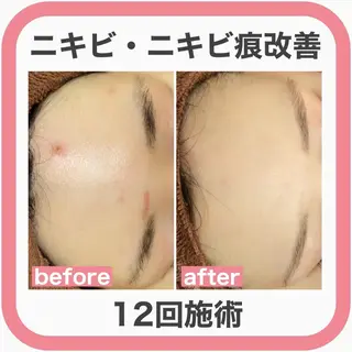 ニキビ跡改善専門🔥 医療にはできない改善のエステ・リラクイメージ