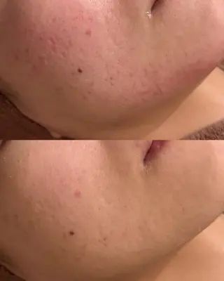 ニキビ跡改善専門🔥 医療にはできない改善のエステ・リラクイメージ