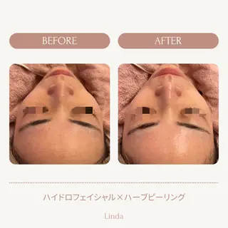 アイラッシュ&エステサロンLinda西宮所属・小顔&毛穴・肌質改善 LINDA西宮 AIのエステ・リラクイメージ