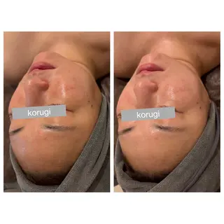 ☆痩身/小顔☆ ハイパーナイフexのエステ・リラクイメージ