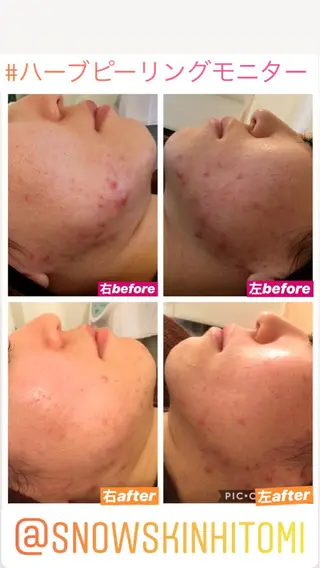 ニキビ/肌質改善専門 Snow skinのエステ・リラクイメージ