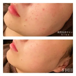 ミディアム カラー パーマ ヘアアレンジ メンズ キッズ ネイル マツエク・マツパ ニキビ跡専門サロン Ainaのエステ・リラクイメージ