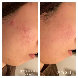 ロング カラー パーマ ヘアアレンジ メンズ キッズ ネイル マツエク・マツパ ニキビ跡専門サロン Ainaのエステ・リラクイメージ