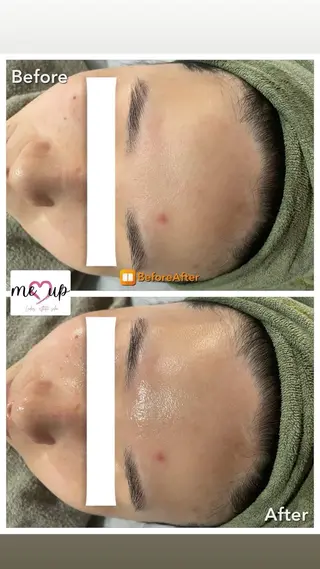 Meupニキビ専門店 背中/ハーブ/肌管理のその他イメージ