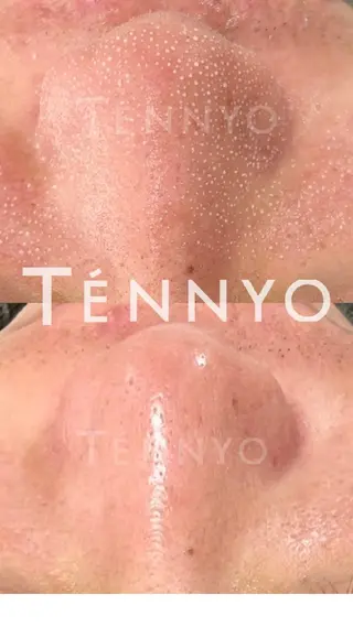 毛穴ケア くすみ肌 ハーブピーリングのエステ・リラクイメージ