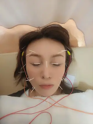 リフトアップ・たるみ ☆美容鍼小顔矯正のその他イメージ