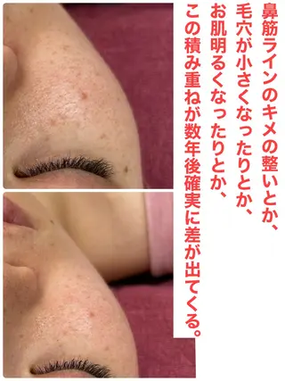 Chalon所属・REVI取扱・肌悩み 毛穴Chalonのエステ・リラクイメージ