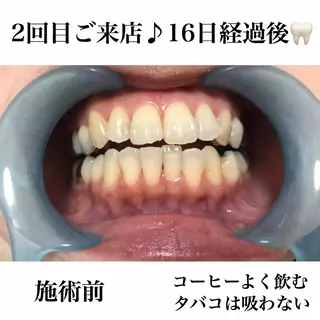 ネイル/耳つぼ /新ホワイトニングのネイルデザイン