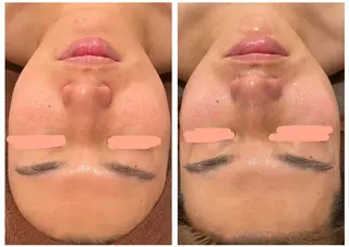 メンズ Meow！～トラブル肌専門ピーリング＆脱毛サロン～所属・トラブル肌改善🏥 Meow！🫧🫧のその他イメージ