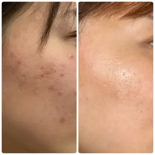 鍼灸•マッサージサロンCalfa所属・《美肌･小顔》美容鍼 ＆マッサージ＊MEIのエステ・リラクイメージ