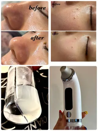 ハーブピーリング/韓国肌管理/フェイシャル/毛穴洗浄/眉毛/顔脱毛【糸脱毛専門】rev所属・ハーブピーリング🌹 毛穴洗浄❤️眉waxのエステ・リラクイメージ