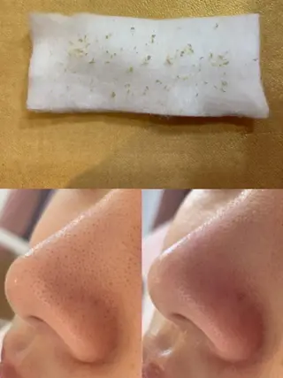 毛穴黒ずみ改善🥇 ✨シフォン豊田✨のエステ・リラクイメージ