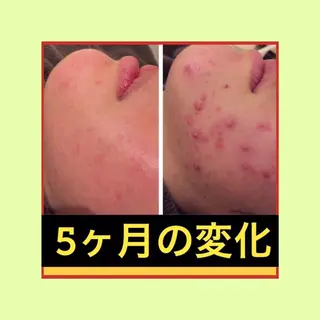 ミディアム パーマ ヘアアレンジ メンズ キッズ ネイル マツエク・マツパ ニキビ・肌質改善専門 ♡人生が変わるサロンのエステ・リラクイメージ