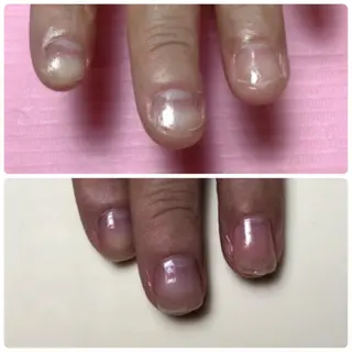 ネイル Nail ビ爪のネイルデザイン