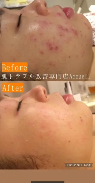 ニキビ特化型エステ 🍓最短で肌質改善のエステ・リラクイメージ