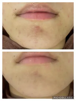 ショート カラー パーマ ヘアアレンジ メンズ キッズ ネイル マツエク・マツパ アイブロウ 🔥3か月で肌革命 🔥ニキビ専門店のエステ・リラクイメージ