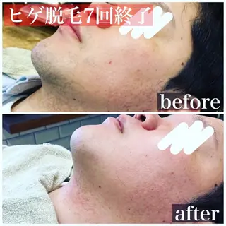 メンズ HAIRS YOSHIOKA所属・ヘアーズヨシオカ MENSヒゲ脱毛のエステ・リラクイメージ