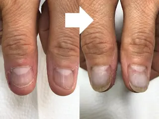 深爪矯正専門サロン　リュリュ所属・深爪矯正専門サロン リュリュのネイルデザイン