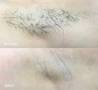 VIO /美肌専門サロン【Beauty  salon Bibiy】所属・VIO美肌専門サロン Bibiyのエステ・リラクイメージ