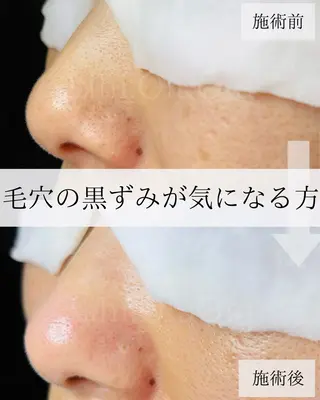 毛穴汚れ改善専門店/ 岸和田/リヒオルオルのエステ・リラクイメージ