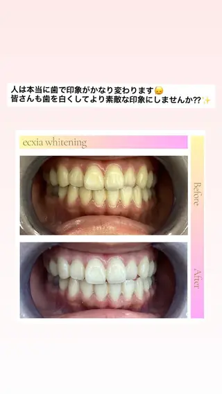 エクシアホワイトニング草津店所属・nanami -ホワイトニングのその他イメージ